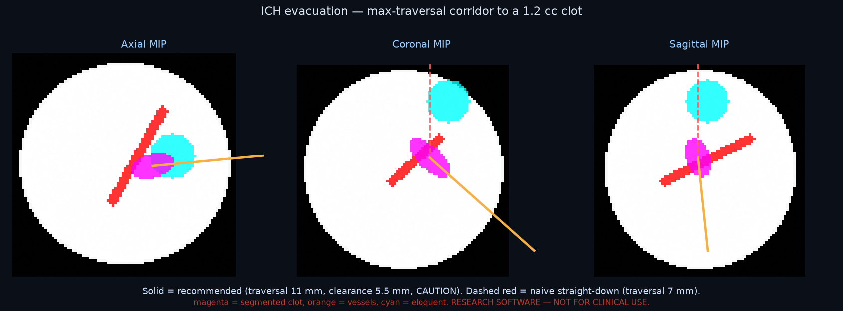 ICH evacuation — max-traversal corridor